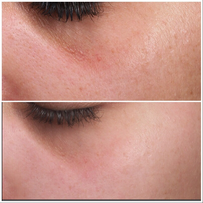 PRP Treatment for face before and after