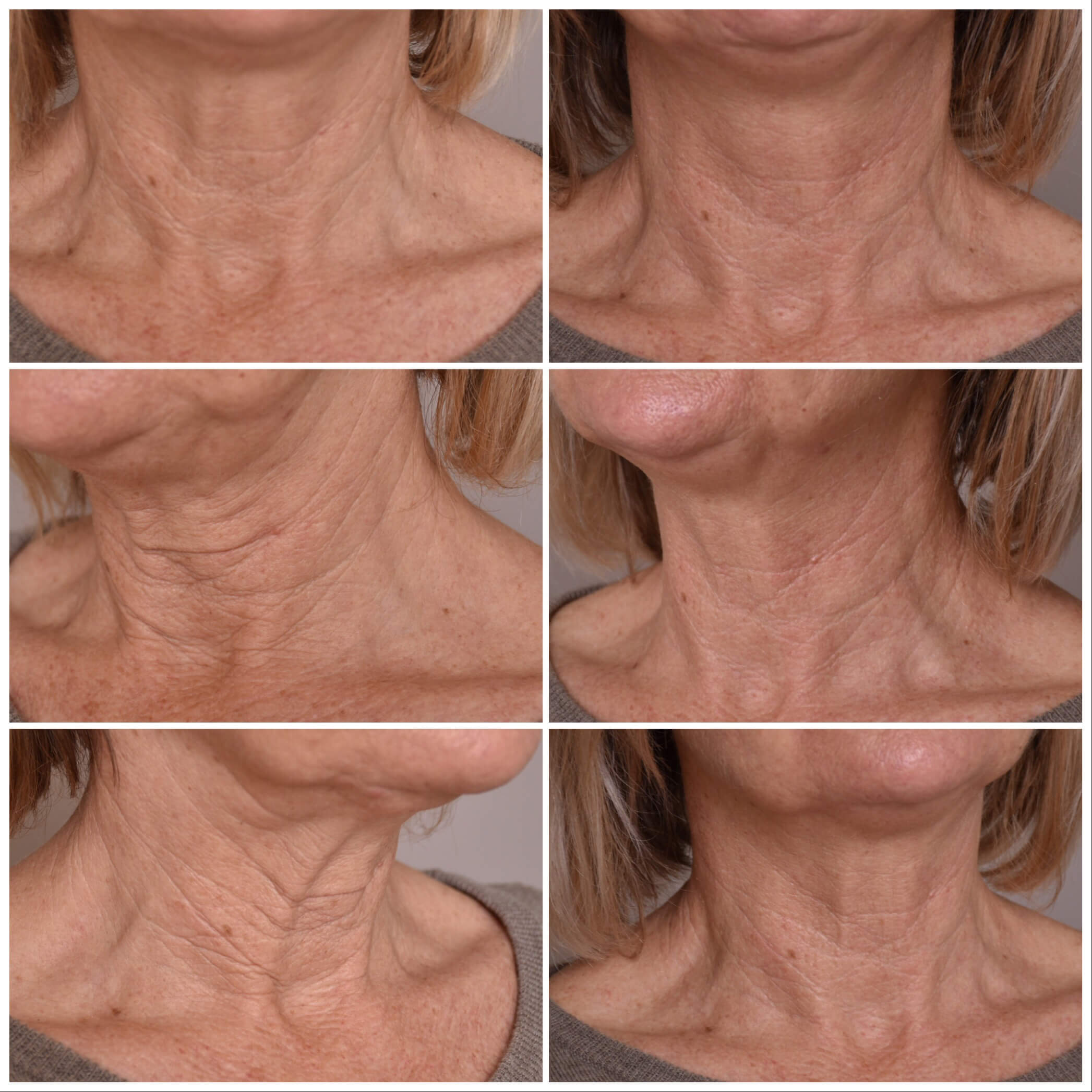 Laser Skin Tightening Treatments for Saggy Skin